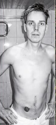 Tommi Sundqvist in hospital during severe Crohn's disease — the before photo from the book's back cover